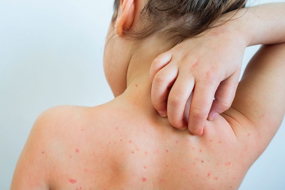 child with chickenpox