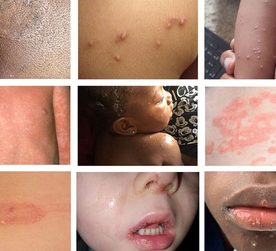 children spots and rashes