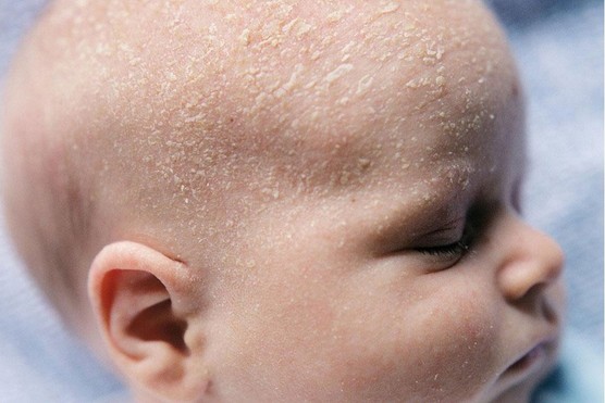 cradle cap on baby's head