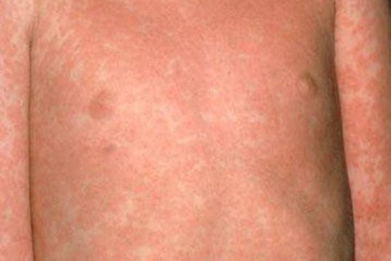 measles rash