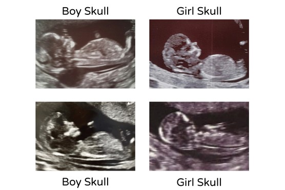 skull theory examples for boy and girl