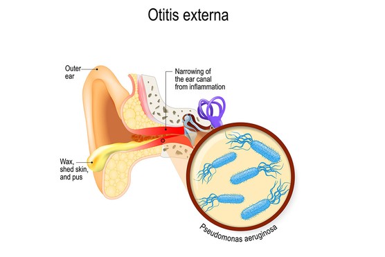 diagram of the ear showing swimmer's ear infection